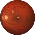 Fundusaufnahme für Netzhaut-Screening mittels KI.